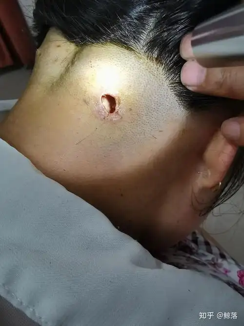 头皮上老是长痘痘,扣了是个血痂要不然就是按着疼的包,这是啥玩意啊?