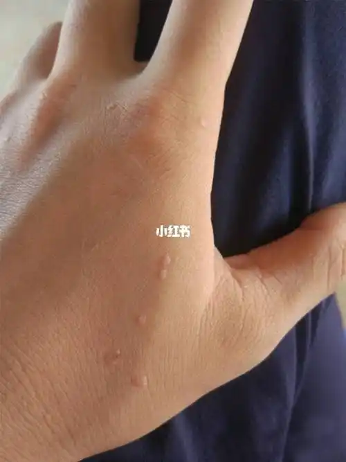 碘伏治扁平疣 碘伏治扁平疣有效果吗