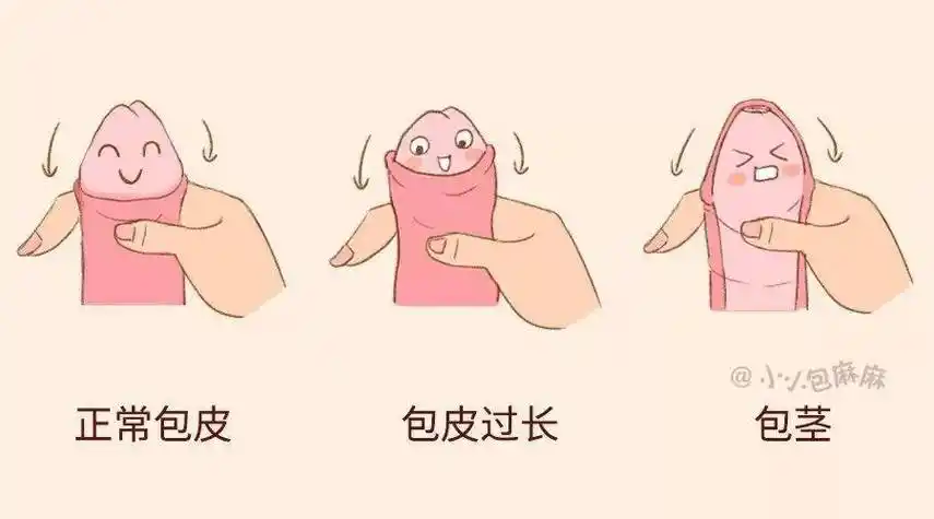 真性包茎嵌顿包茎包皮过长并红肿,阴茎反复发炎孩子几岁去割比较好呢?