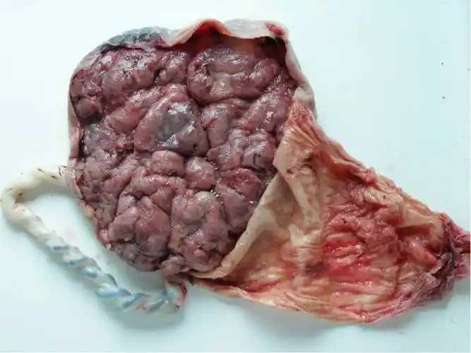 为何要将胎盘送检,又有谁知道它的临床意义?