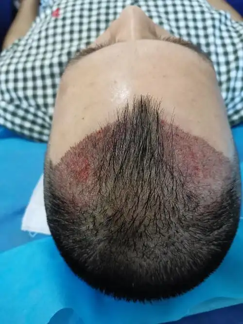 年纪轻轻的秃鬓角挺严重的,之前听说有植发技术,因为_圈子-新氧美容