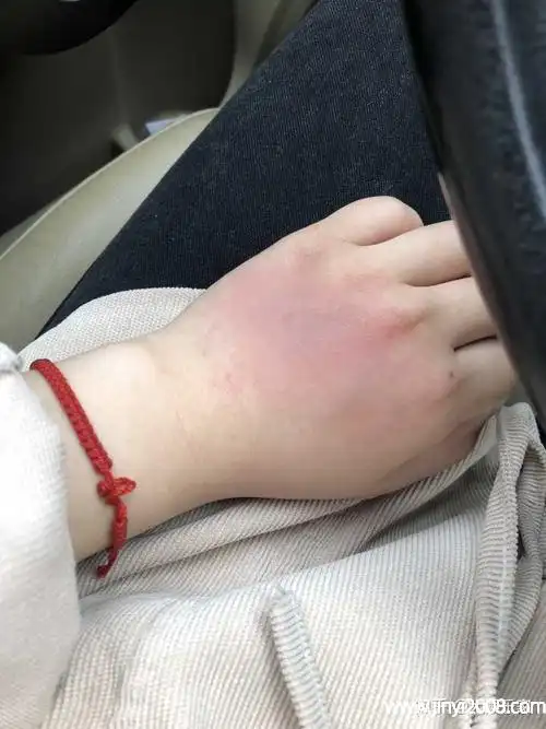 具体恢复时间需要根据个人的体质以及烫伤的严重程度来决定,如果非常