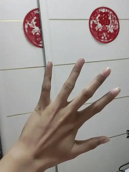 这也太像了,吓死我了#马凡氏综合症  #健康 #医学 #手长