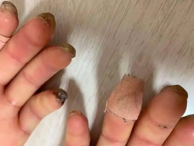 天气一冷手指就变色嘉兴女性险些被截肢专家这种疾病天冷高发