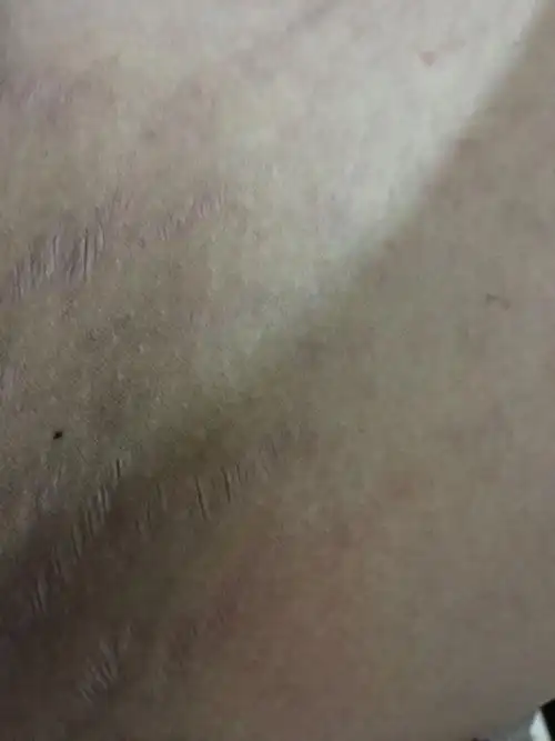 皮肤出现褶皱还发黑为什么