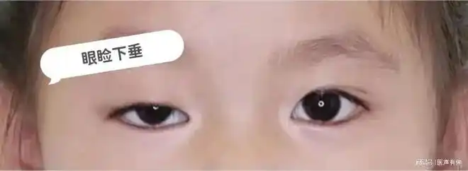 其临床表现为眼睑下垂,饮水咳呛,吞咽困难,表情僵硬及四肢无力,严重时