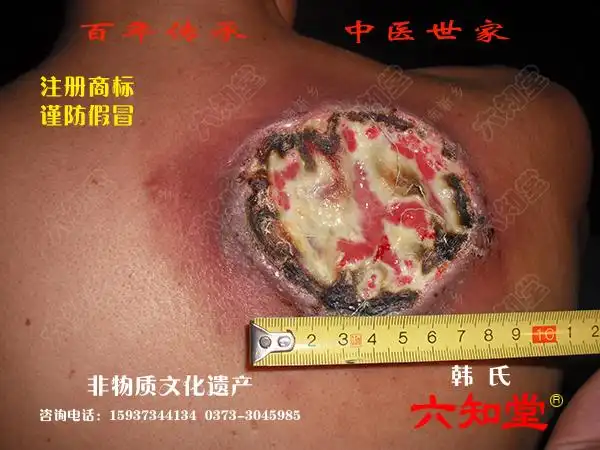 病情反而突然加重,患处皮肤出现坏死,剪切后继续呈扩大蔓延趋势,面对