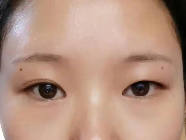眼睛一个单眼皮一个双眼皮怎么办