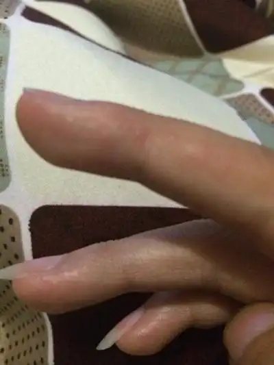 手指湿疹症状图片60