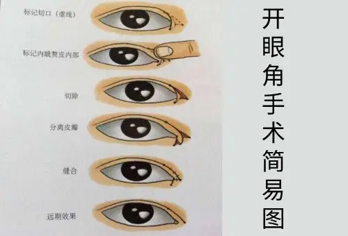 开眼角手术示意图