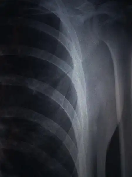 求骨科大夫帮助,肩胛骨下角骨骨折,求帮助,求指导