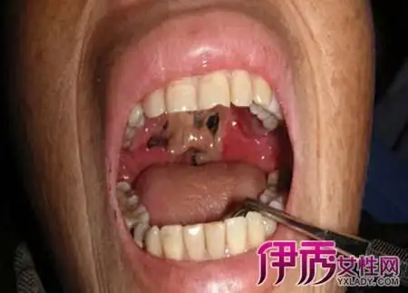 【图】活人的身体腐烂长蛆虫是真的么? 人身上长蛆怎么办?