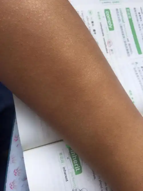 手臂毛孔周围发白,毛孔上有很小很小排泄物,一晒太阳或者热水洗澡稍微