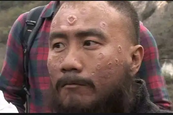 麻面脸面相,麻子脸的面相,麻面和青须分别是指什么,为什么这样的人不