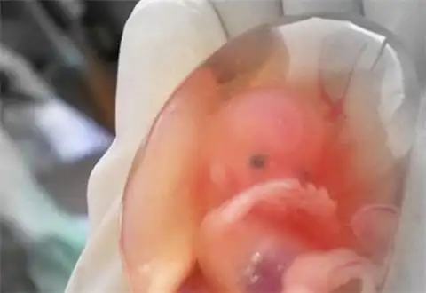 打胎药都没将胎儿打掉,宝宝出生后妈妈热泪盈眶!