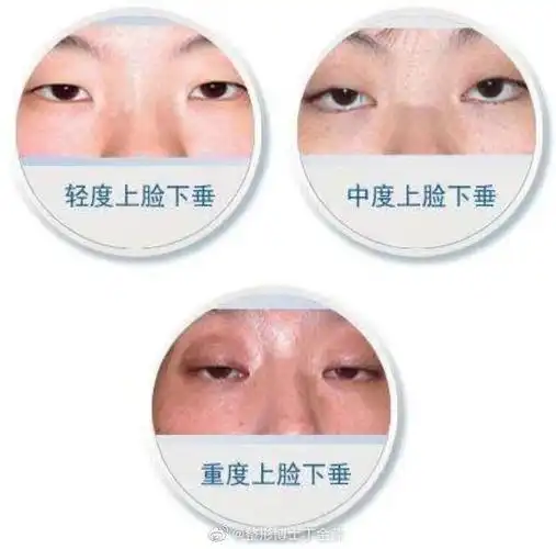 上睑下垂的原因是什么?