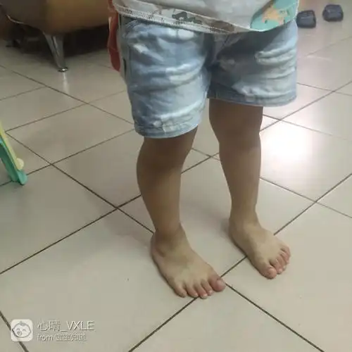 三岁半o型腿走路内八字有矫正好的吗_百度宝宝知道