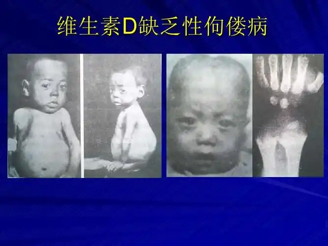维生素d缺乏性佝偻病
