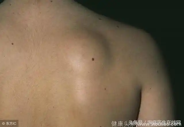 预防脂肪瘤,推荐3款食疗方