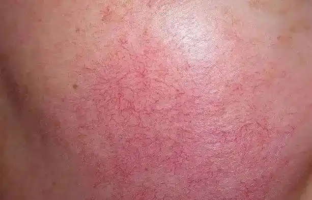 红血丝皮肤如何护理与保养?