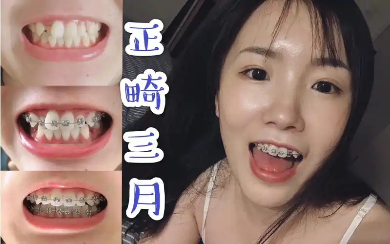 正畸分享戴牙套三个月牙齿就排齐了来看看对比图持续更新
