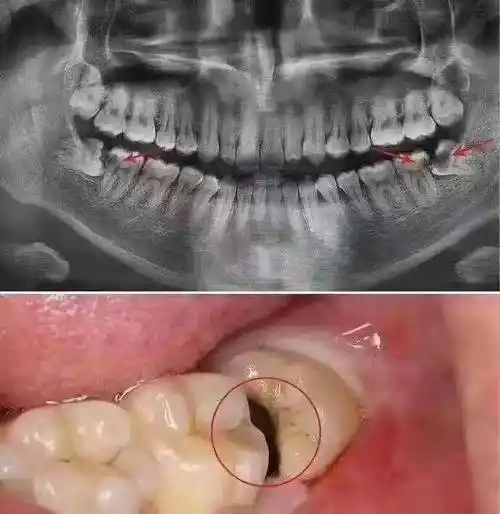 智齿_时候_酒窝