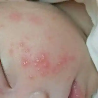 宝妈们,请问这属於湿疹还是热疹啊?有解决的方子吗?