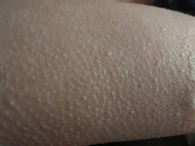 问:我的皮肤这样,像是一遇冷起的鸡皮疙瘩!怎么办?这是什么皮肤?