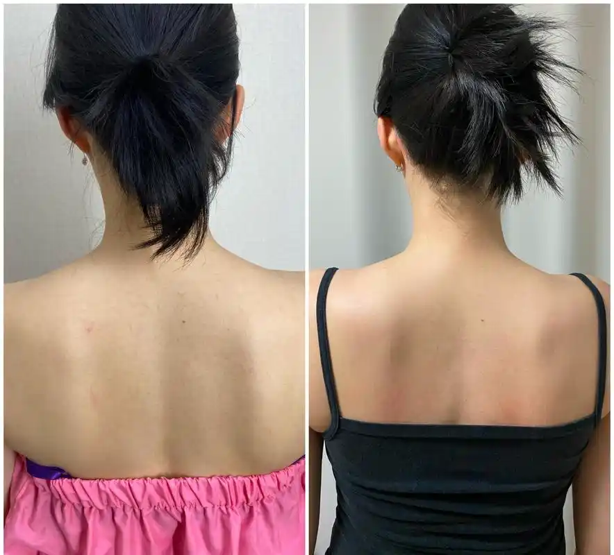 斜方肌严重的瘦肩针真的很值得打!