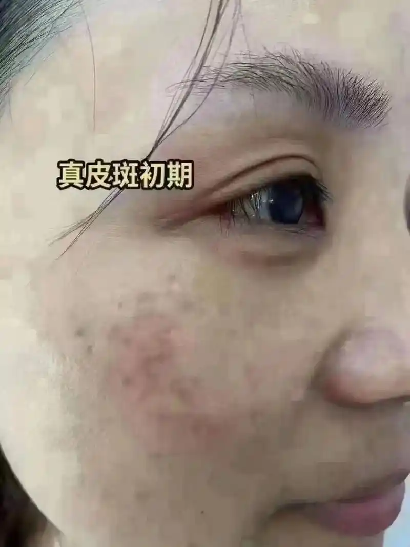 真皮斑是颗粒状的,一开始长在眼角下方 - 抖音