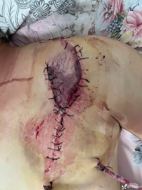 皮瓣坏死,后期如何处理!