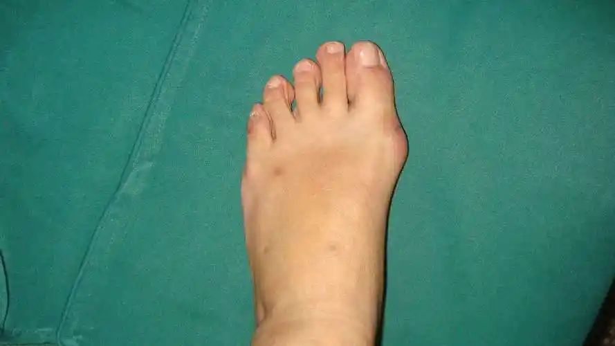 拇外翻术前术后对比照片1