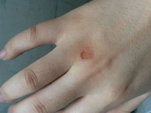 手背被热熔胶棒烫伤了直接撕掉了手上的胶把皮也一起撕掉了