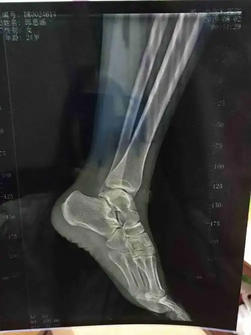 2开车被撞到,导致脚崴了,求各位大神看这样的片子有没有问题,到现在半