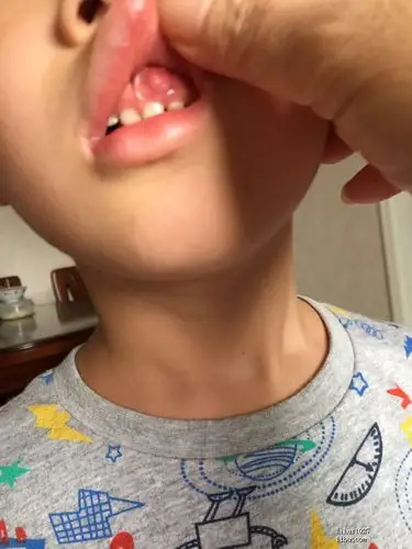 请帮忙看看孩子牙龈上长的是什么 老干部闲聊 篱笆网 - 年轻家庭 生活