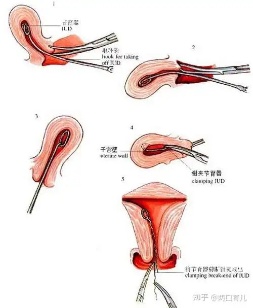 避孕环是会有脱落,损坏的可能,避孕效率不可能百分之百 2.