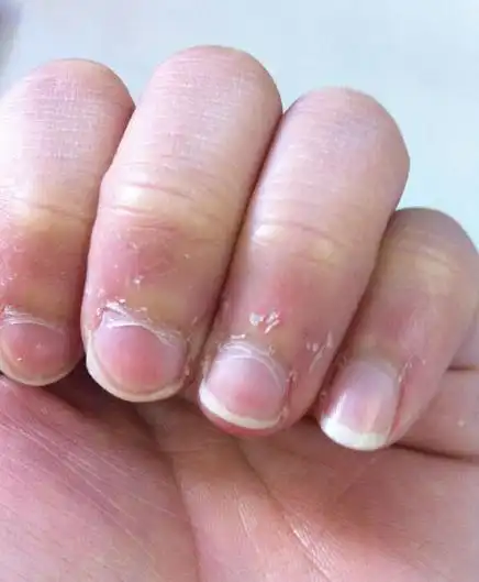 手指上肉刺好多怎么办