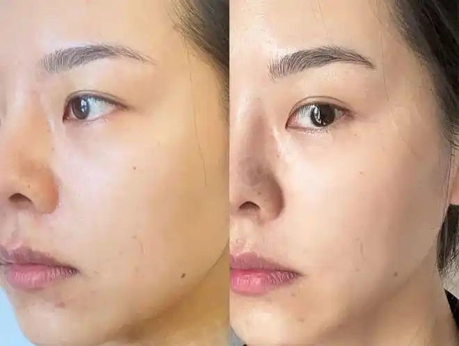 hani亲测|无论皮肤状态好坏,我都会坚持做的本命医美