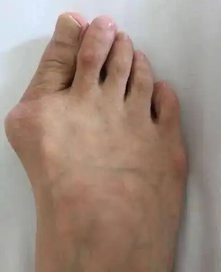 别了又丑又痛又磨人的大脚骨