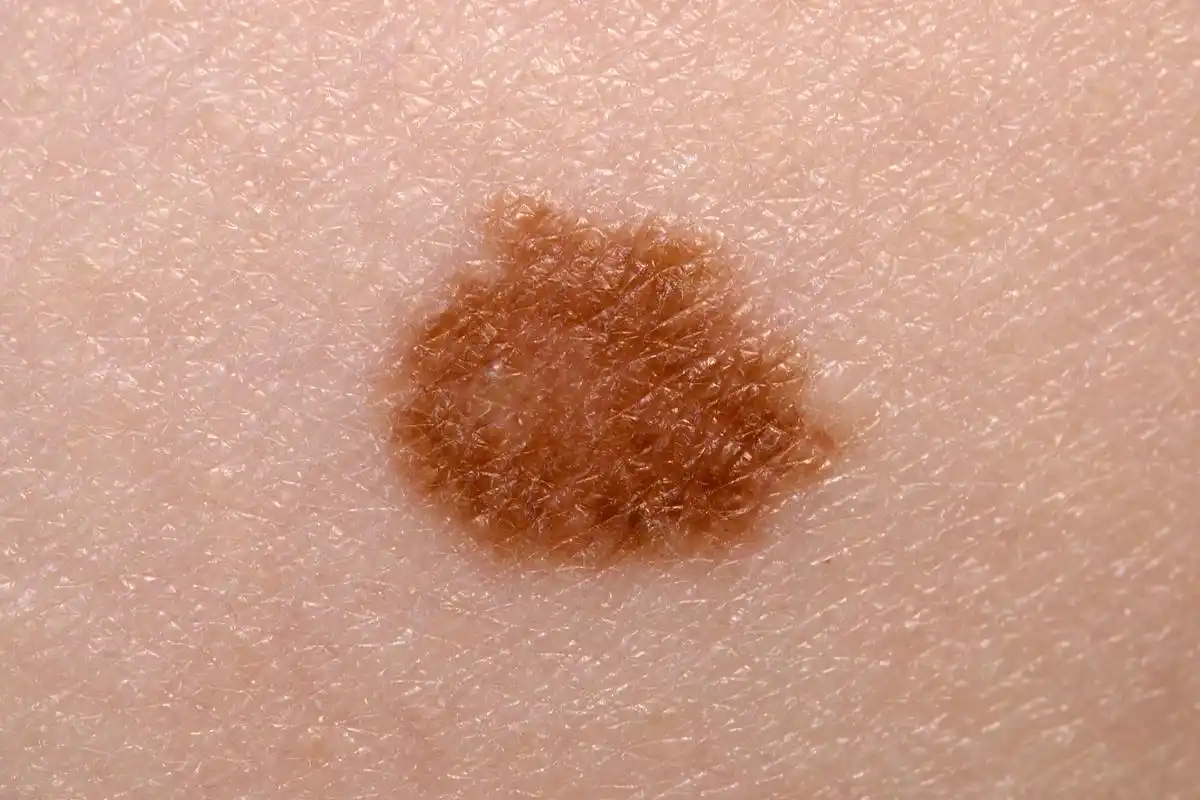 女性比男性更容易患上该疾病,而白种人比黑种人更容易患上色素痣.