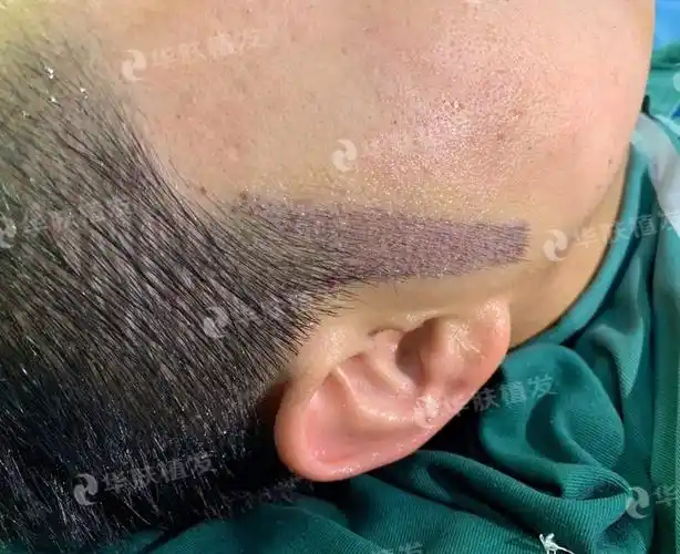 鬓角种植毛发成活率高吗?