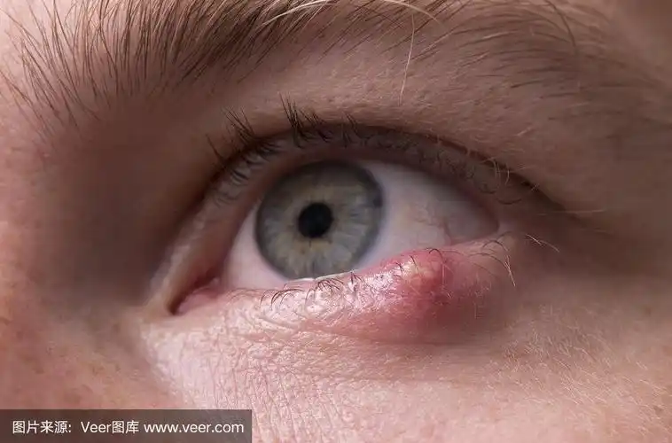 靠近感染的眼睛,下眼睑有疼痛的肿块.