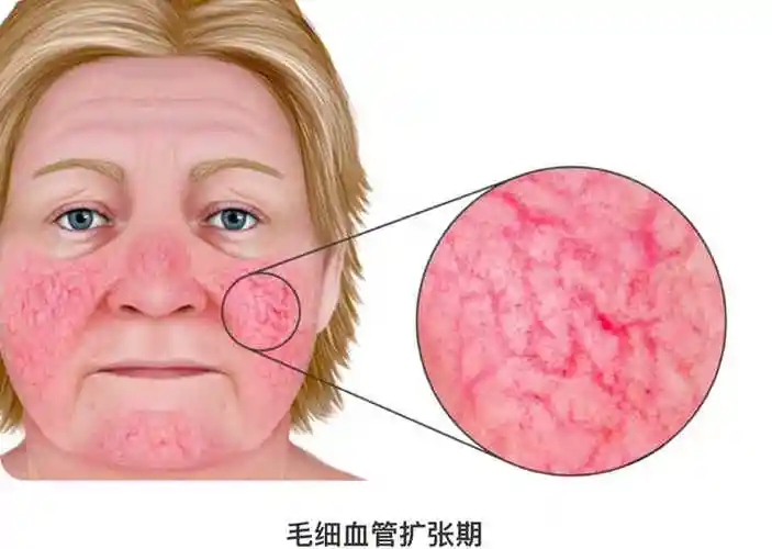 不普通的痤疮——玫瑰痤疮,啥来头?可以怎么治?