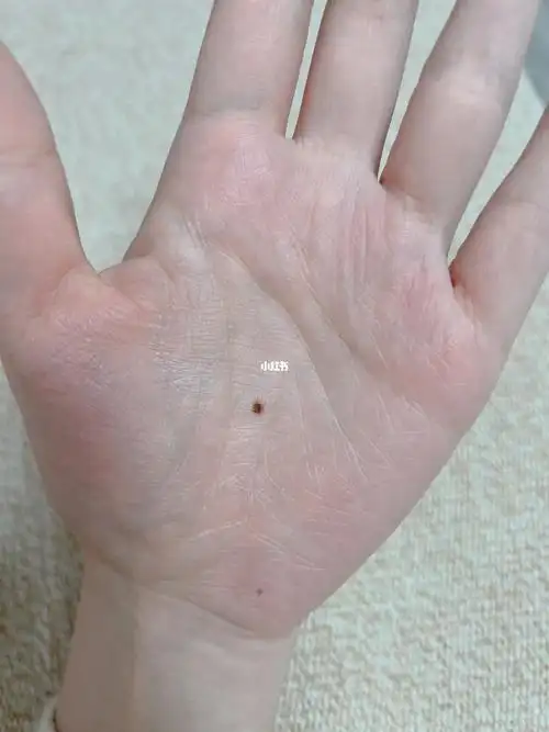 左手掌心痣