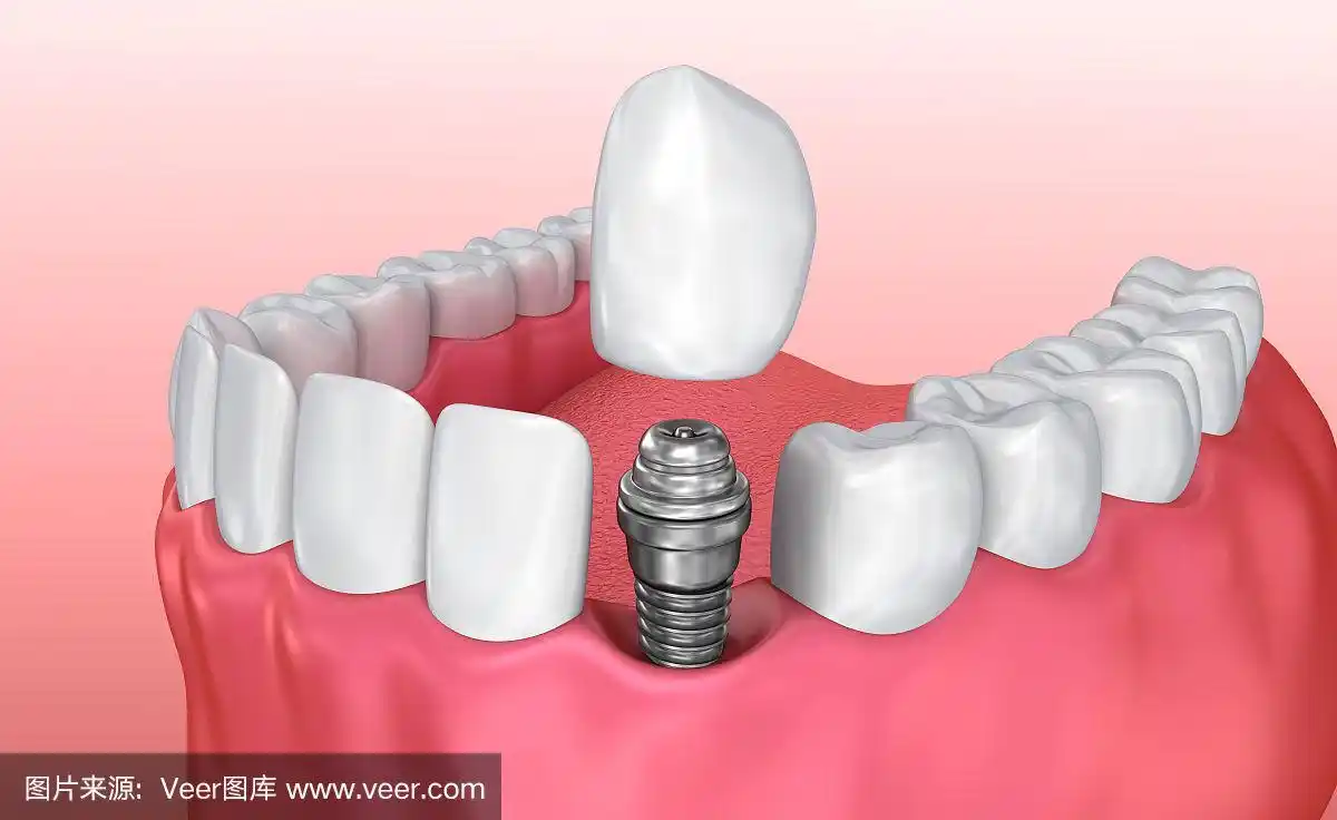种植牙安装过程,医学精确3d插图白色风格