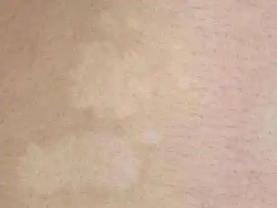 花斑癣,如何联合用药?_手机搜狐网