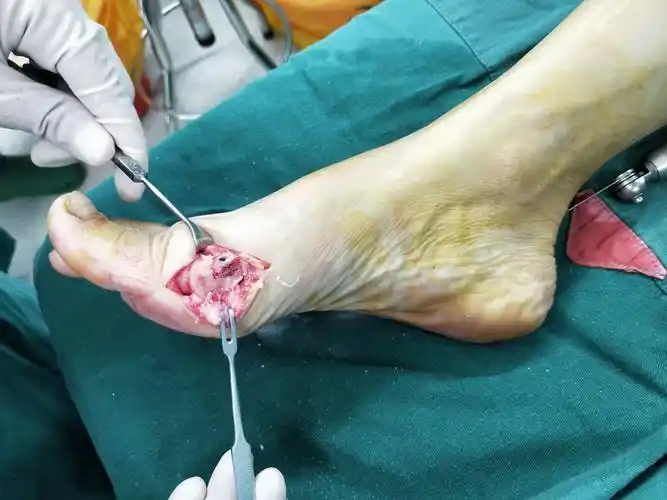 在临床选择中有很多种方法,根据跖骨截骨部位大致分为远端截骨,中段截