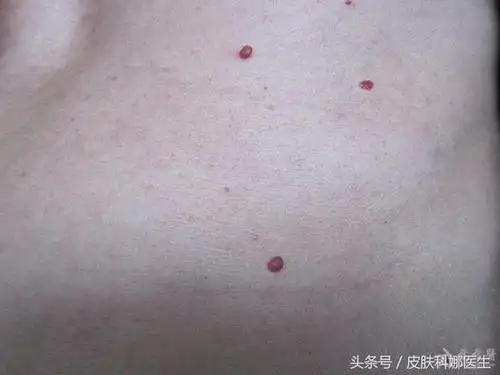 皮肤红血丝怎么办红血丝形成的原因