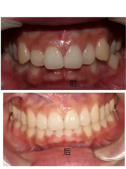 25岁大龄矫正前后对比(图片比较辣眼,所以换成黑白色)