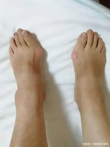 大脚骨的传奇就医经历